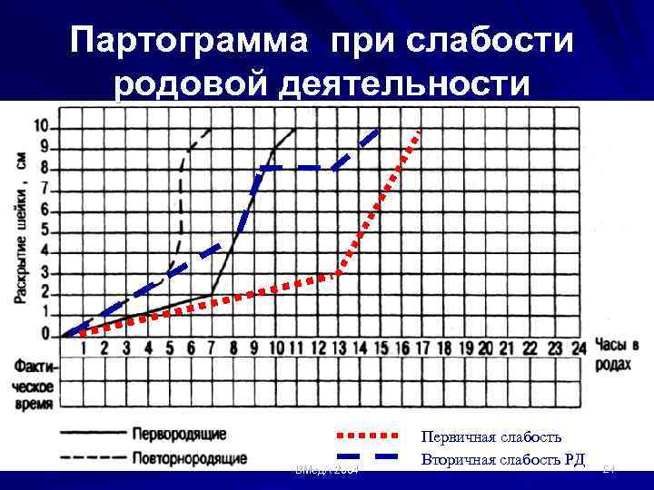 Партограмма при слабости родовой деятельности ВМед. А 2004 Первичная слабость Вторичная слабость РД 24