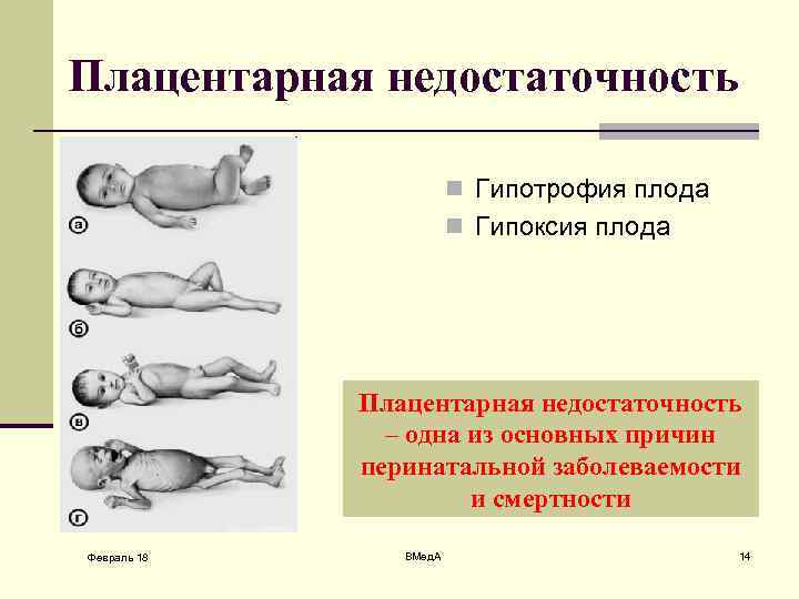 Плацентарная недостаточность n Гипотрофия плода n Гипоксия плода Плацентарная недостаточность – одна из основных