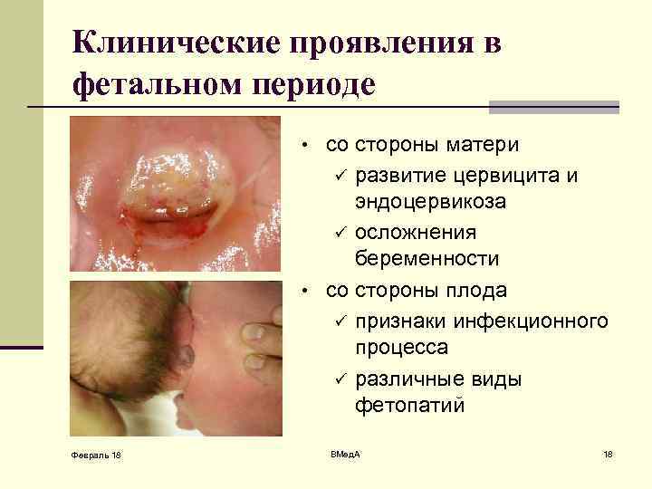 Клинические проявления в фетальном периоде • со стороны матери развитие цервицита и эндоцервикоза ü