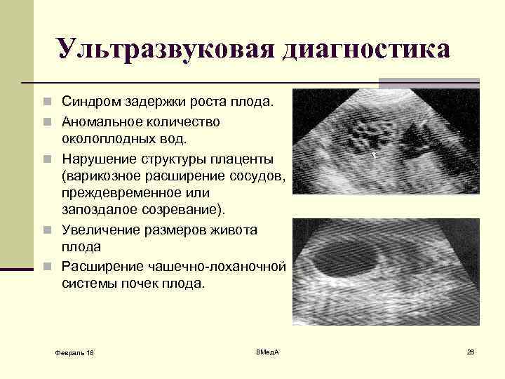 Ультразвуковая диагностика n Синдром задержки роста плода. n Аномальное количество околоплодных вод. n Нарушение