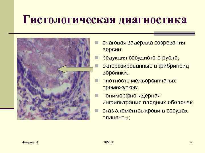 Гистологическая диагностика n очаговая задержка созревания n n n Февраль 18 ворсин; редукция сосудистого