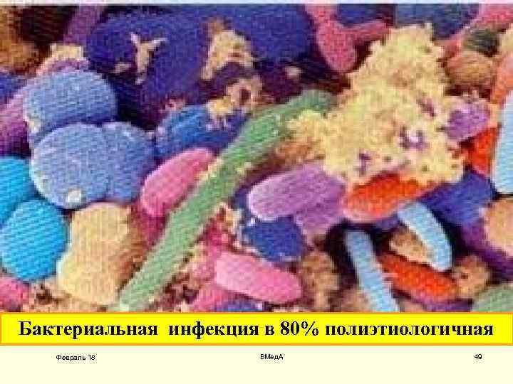 Бактериальная инфекция в 80% полиэтиологичная Февраль 18 ВМед. А 49 