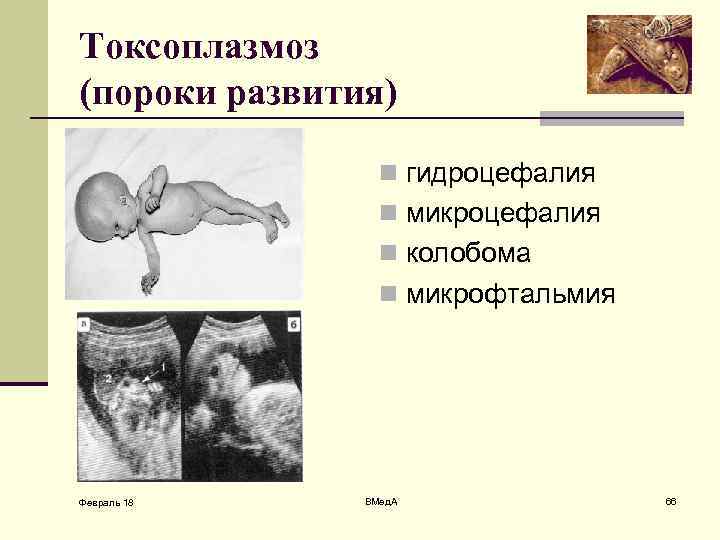 Токсоплазмоз (пороки развития) n гидроцефалия n микроцефалия n колобома n микрофтальмия Февраль 18 ВМед.