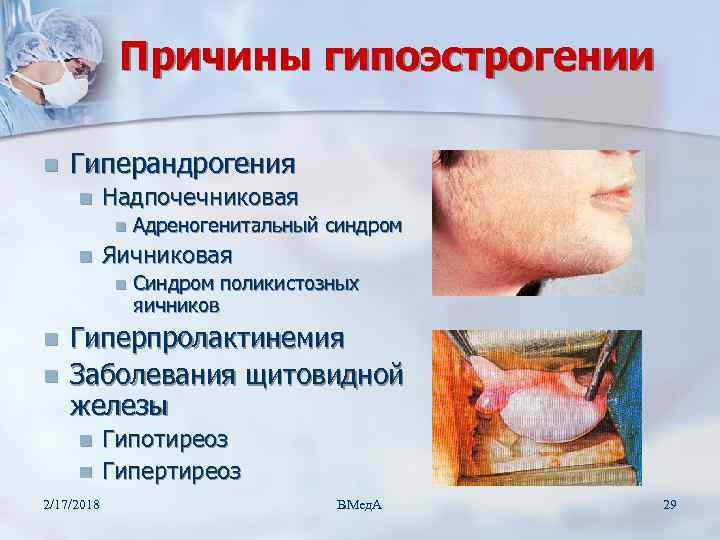 Причины гипоэстрогении n Гиперандрогения n Надпочечниковая n n Яичниковая n n n Адреногенитальный синдром