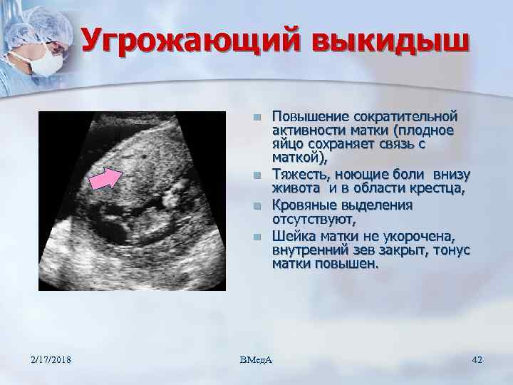 Угрожающий выкидыш n n 2/17/2018 Повышение сократительной активности матки (плодное яйцо сохраняет связь с