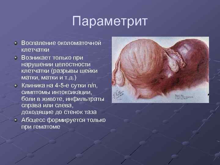 Параметрит Воспаление околоматочной клетчатки Возникает только при нарушении целостности клетчатки (разрывы шейки матки, матки