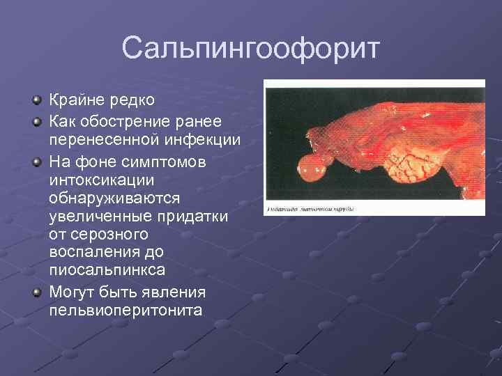 Сальпингоофорит Крайне редко Как обострение ранее перенесенной инфекции На фоне симптомов интоксикации обнаруживаются увеличенные