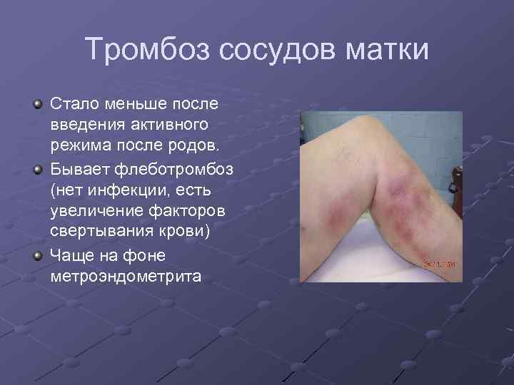 Тромбоз сосудов матки Стало меньше после введения активного режима после родов. Бывает флеботромбоз (нет