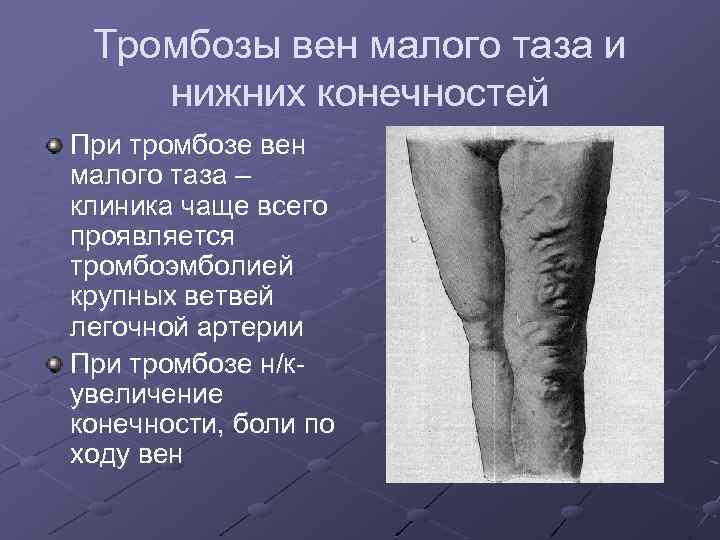 Тромбозы вен малого таза и нижних конечностей При тромбозе вен малого таза – клиника