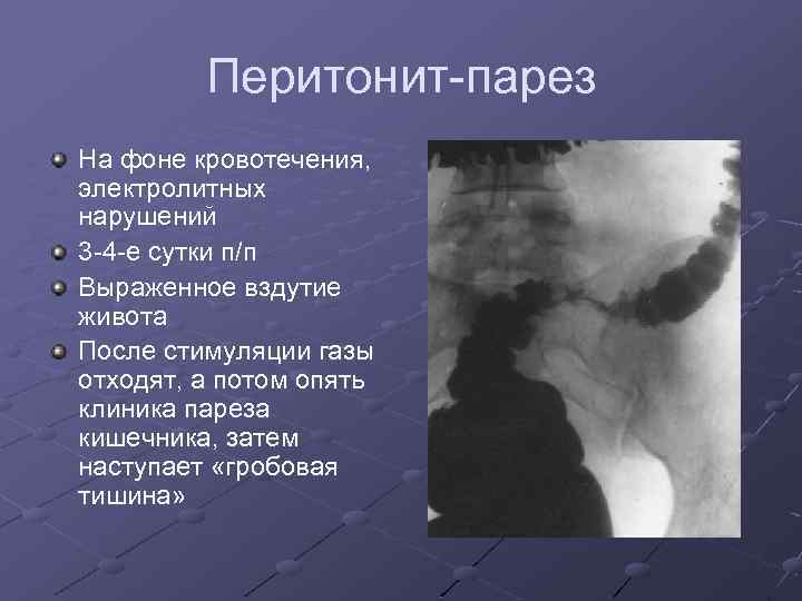 Перитонит-парез На фоне кровотечения, электролитных нарушений 3 -4 -е сутки п/п Выраженное вздутие живота