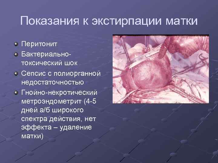 Показания к экстирпации матки Перитонит Бактериальнотоксический шок Сепсис с полиорганной недостаточностью Гнойно-некротический метроэндометрит (4