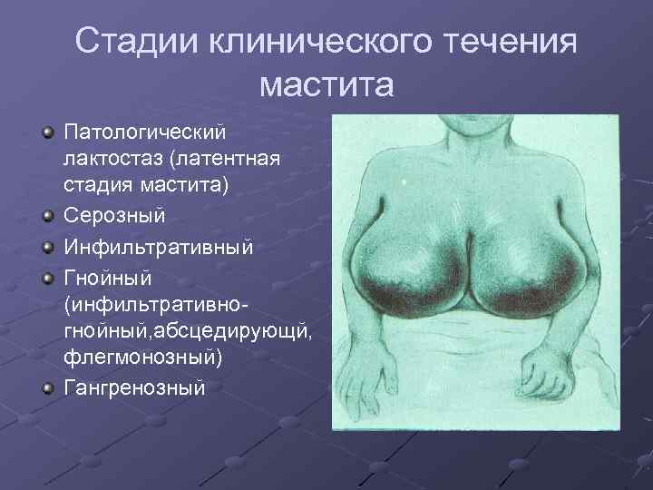 Стадии клинического течения мастита Патологический лактостаз (латентная стадия мастита) Серозный Инфильтративный Гнойный (инфильтративногнойный, абсцедирующй,