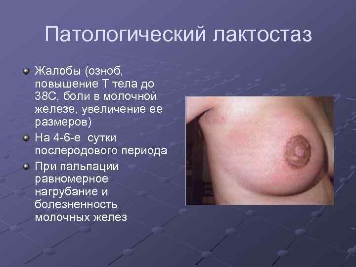 Патологический лактостаз Жалобы (озноб, повышение Т тела до 38 С, боли в молочной железе,
