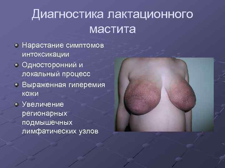 Диагностика лактационного мастита Нарастание симптомов интоксикации Односторонний и локальный процесс Выраженная гиперемия кожи Увеличение