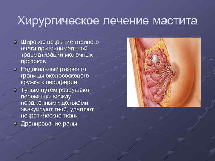 Хирургическое лечение мастита Широкое вскрытие гнойного очага при минимальной травматизации молочных протоков Радикальный разрез