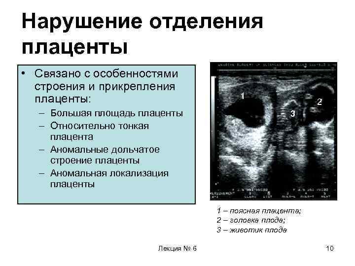 Нарушение отделения плаценты • Связано с особенностями строения и прикрепления плаценты: – Большая площадь