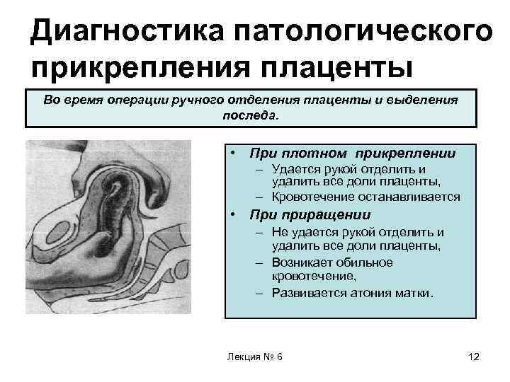 Диагностика патологического прикрепления плаценты Во время операции ручного отделения плаценты и выделения последа. •