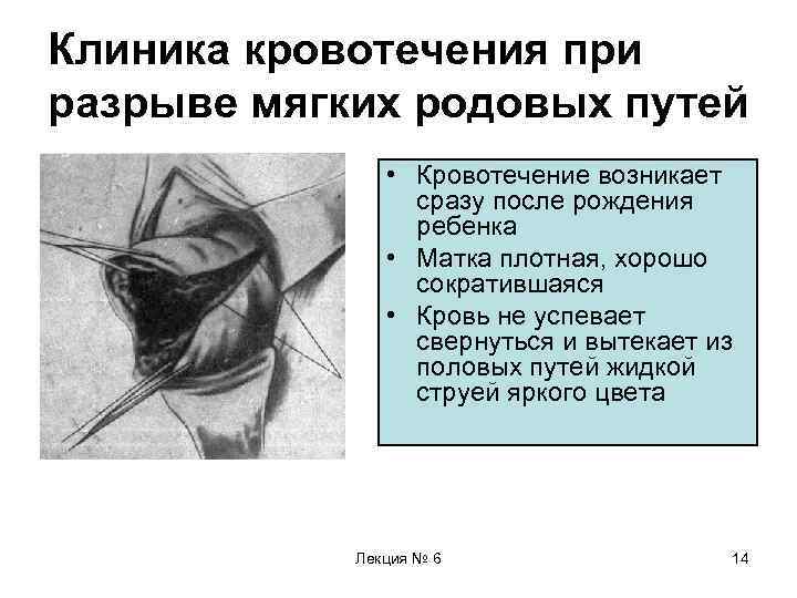 Клиника кровотечения при разрыве мягких родовых путей • Кровотечение возникает сразу после рождения ребенка