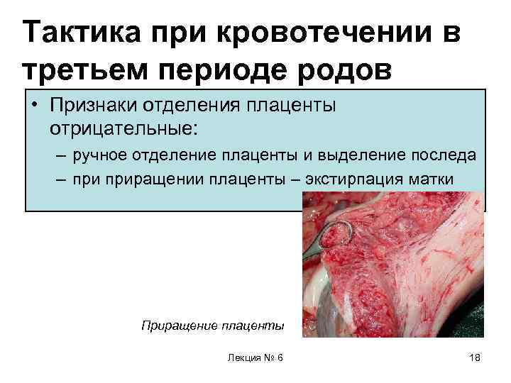 Тактика при кровотечении в третьем периоде родов • Признаки отделения плаценты отрицательные: – ручное