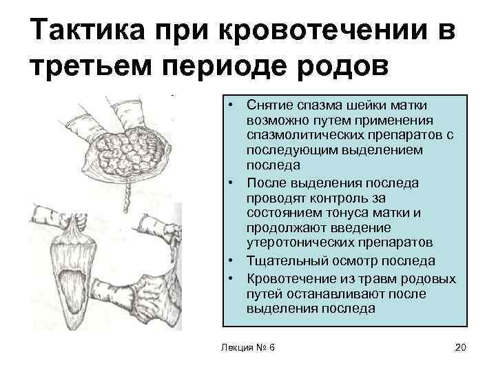 Тактика при кровотечении в третьем периоде родов • Снятие спазма шейки матки возможно путем