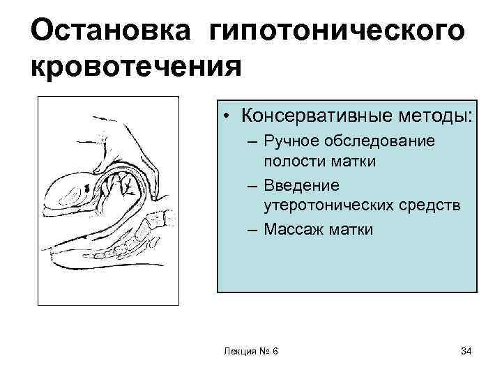 Остановка гипотонического кровотечения • Консервативные методы: – Ручное обследование полости матки – Введение утеротонических