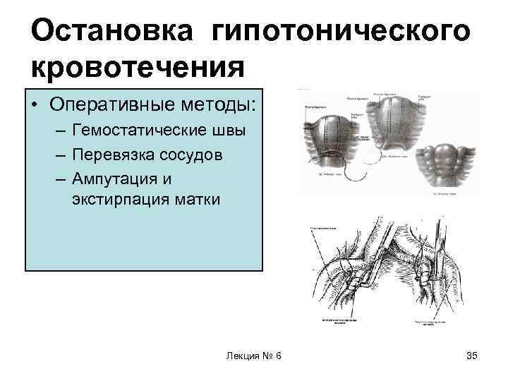 Остановка гипотонического кровотечения • Оперативные методы: – Гемостатические швы – Перевязка сосудов – Ампутация