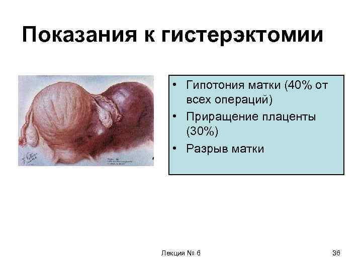 Показания к гистерэктомии • Гипотония матки (40% от всех операций) • Приращение плаценты (30%)