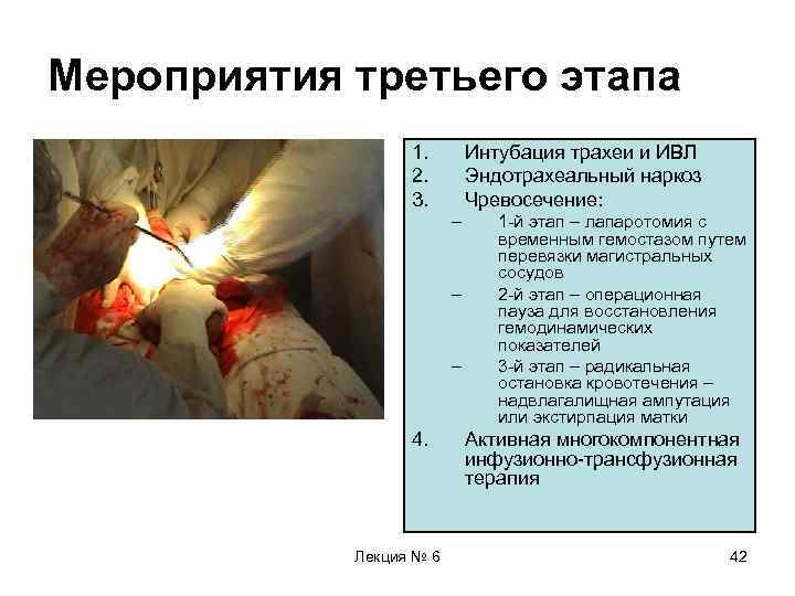 Мероприятия третьего этапа 1. 2. 3. Интубация трахеи и ИВЛ Эндотрахеальный наркоз Чревосечение: –