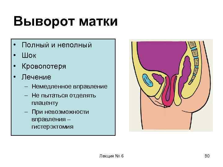 Выворот матки • • Полный и неполный Шок Кровопотеря Лечение – Немедленное вправление –