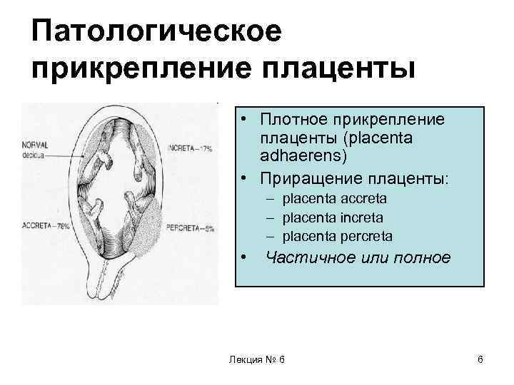 Патологическое прикрепление плаценты • Плотное прикрепление плаценты (placenta adhaerens) • Приращение плаценты: – placenta