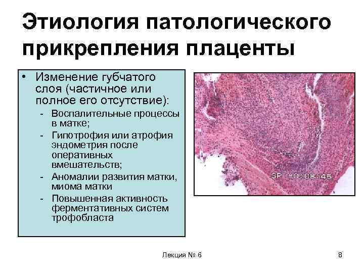 Этиология патологического прикрепления плаценты • Изменение губчатого слоя (частичное или полное его отсутствие): -