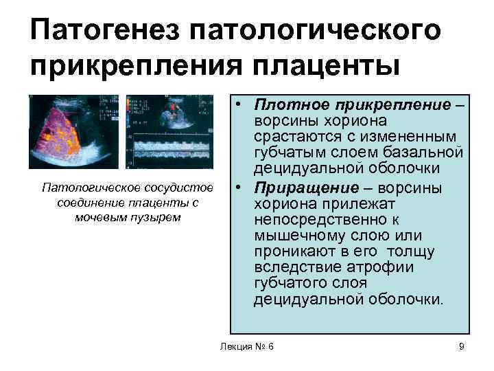 Патогенез патологического прикрепления плаценты Патологическое сосудистое соединение плаценты с мочевым пузырем • Плотное прикрепление