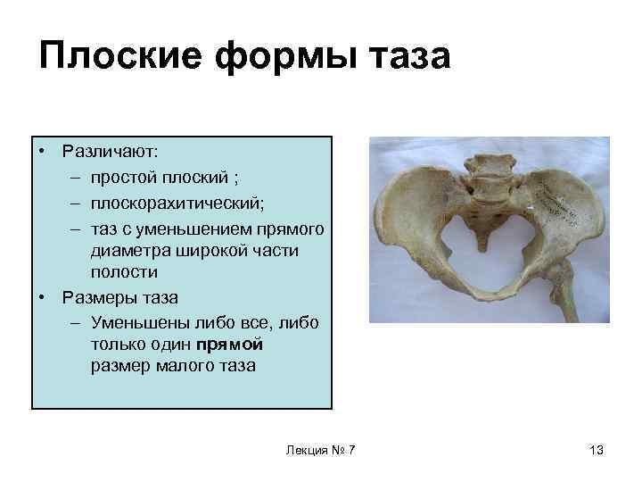 Плоские формы таза • Различают: – простой плоский ; – плоскорахитический; – таз с