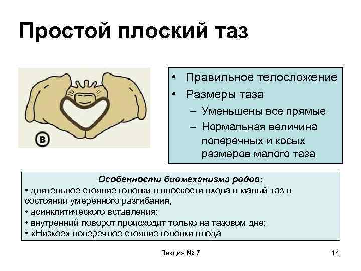 Простой плоский таз • Правильное телосложение • Размеры таза – Уменьшены все прямые –