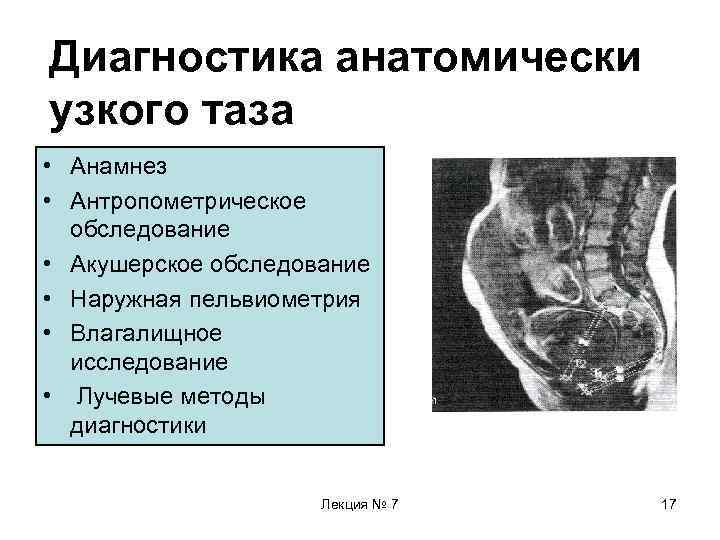 Диагностика анатомически узкого таза • Анамнез • Антропометрическое обследование • Акушерское обследование • Наружная