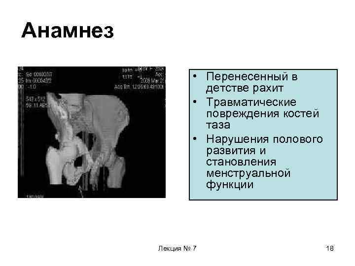 Анамнез • Перенесенный в детстве рахит • Травматические повреждения костей таза • Нарушения полового