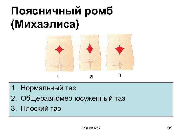 Поясничный ромб (Михаэлиса) 1 2 1 3 1. Нормальный таз 2. Общеравномерносуженный таз 3.