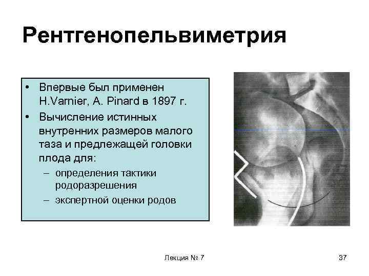 Рентгенопельвиметрия • Впервые был применен H. Varnier, A. Pinard в 1897 г. • Вычисление