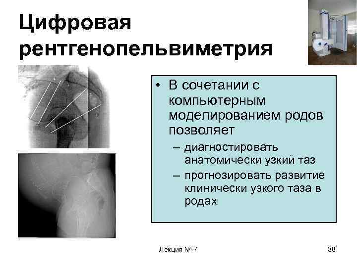 Цифровая рентгенопельвиметрия • В сочетании с компьютерным моделированием родов позволяет – диагностировать анатомически узкий