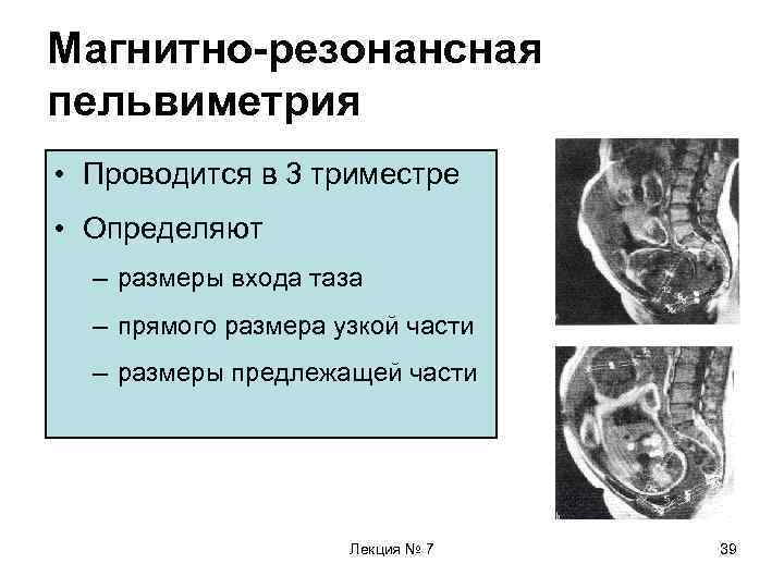 Магнитно-резонансная пельвиметрия • Проводится в 3 триместре • Определяют – размеры входа таза –