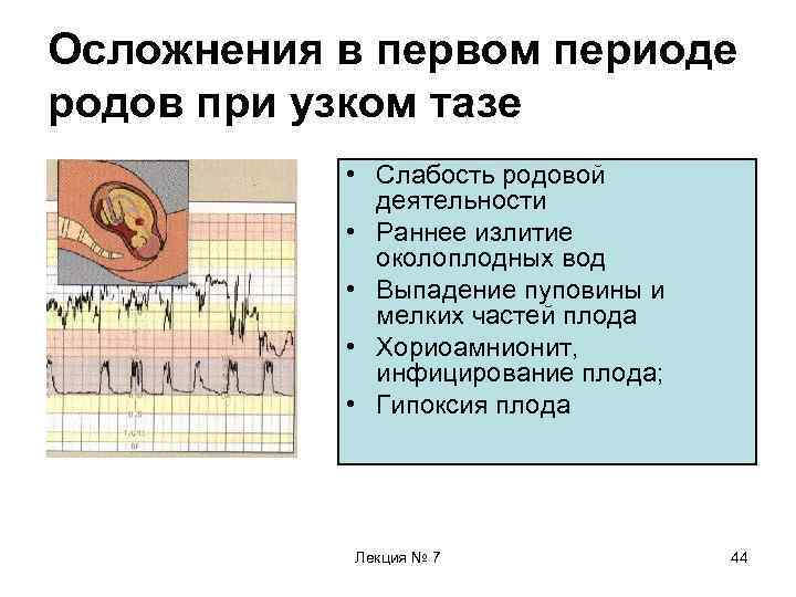 Осложнения в первом периоде родов при узком тазе • Слабость родовой деятельности • Раннее