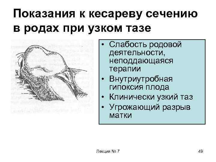 Показания к кесареву сечению в родах при узком тазе • Слабость родовой деятельности, неподдающаяся