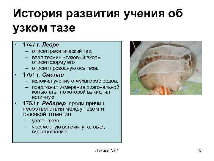 История развития учения об узком тазе • 1747 г. Левре – описал рахитический таз,