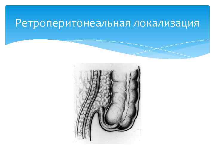 Варианты аппендикса. Ретроцекальный аппендицит. Ретроцекальное ретроперитонеальное расположение аппендикса. Червеобразный отросток ретроперитонеально. Ретроцекальный острый аппендицит.