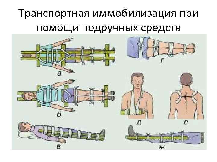 Транспортная иммобилизация картинки