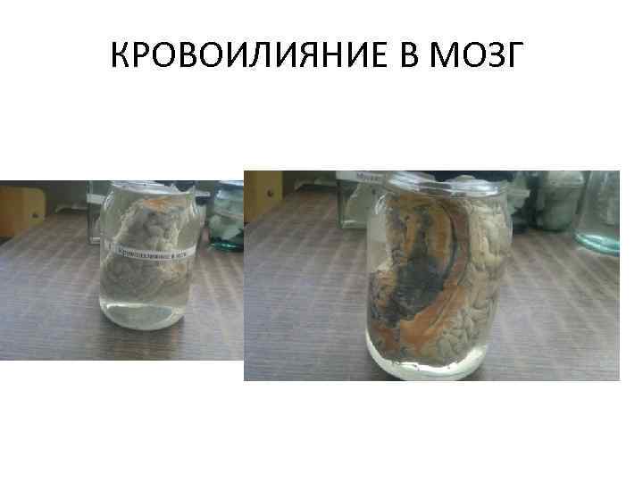 КРОВОИЛИЯНИЕ В МОЗГ 