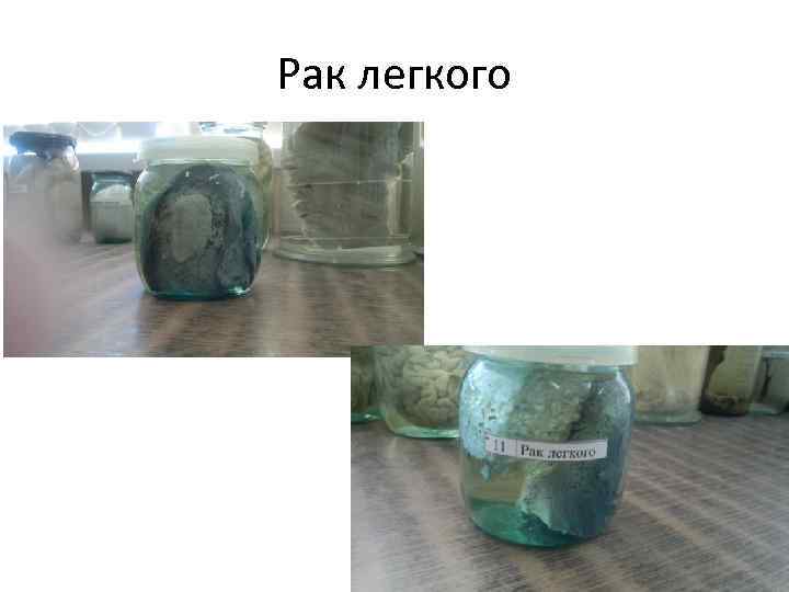 Рак легкого 