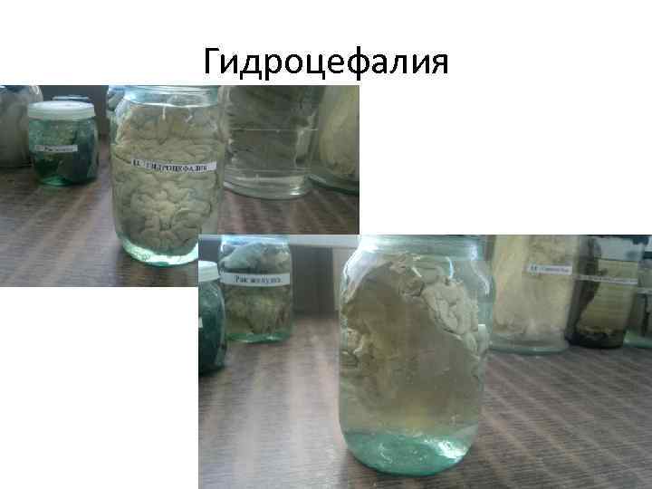 Гидроцефалия 