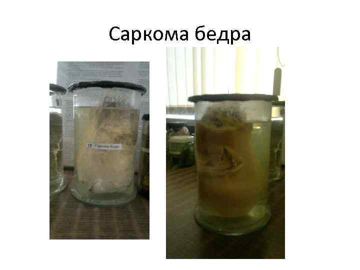 Саркома бедра 