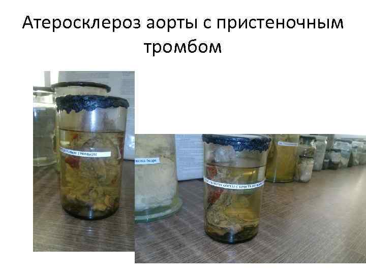 Атеросклероз аорты с пристеночным тромбом 